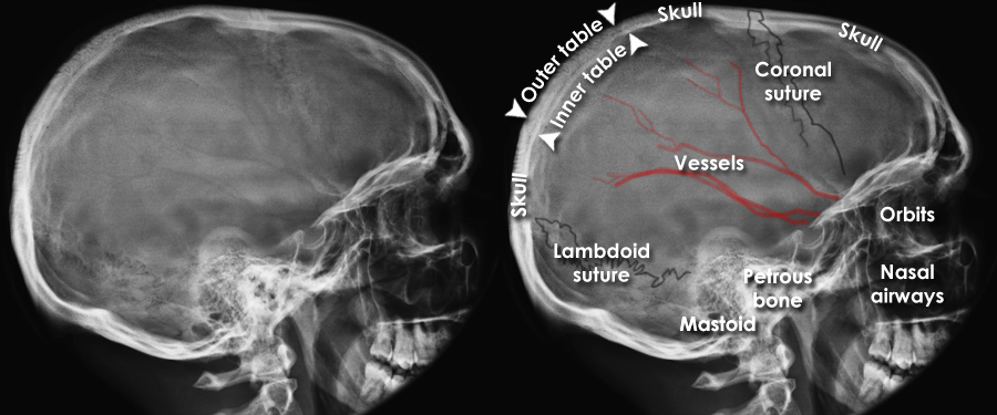 Trauma X-ray - Axial skeleton - Skull