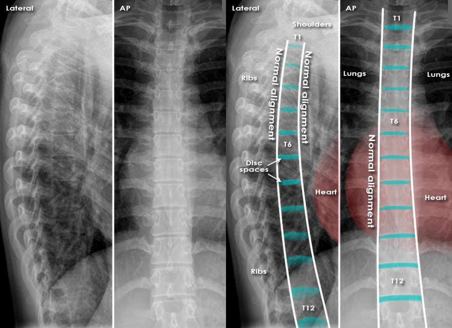 Trauma X-ray - Axial skeleton - Thoracolumbar spine - Normal anatomy