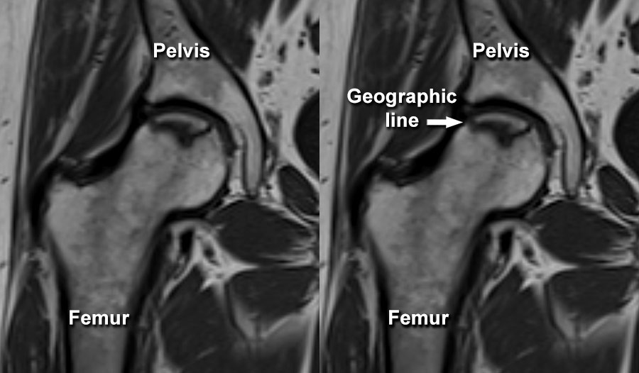 Imaging of Musculoskeletal Disorders Avascular necrosis