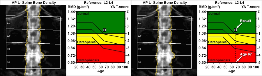 Bone Density (DEXA) Scan