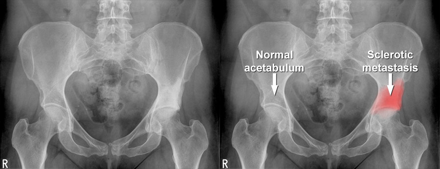 Bone Metastases Images and Xrays