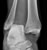 ankle_dislocation_a1_thumb.jpg