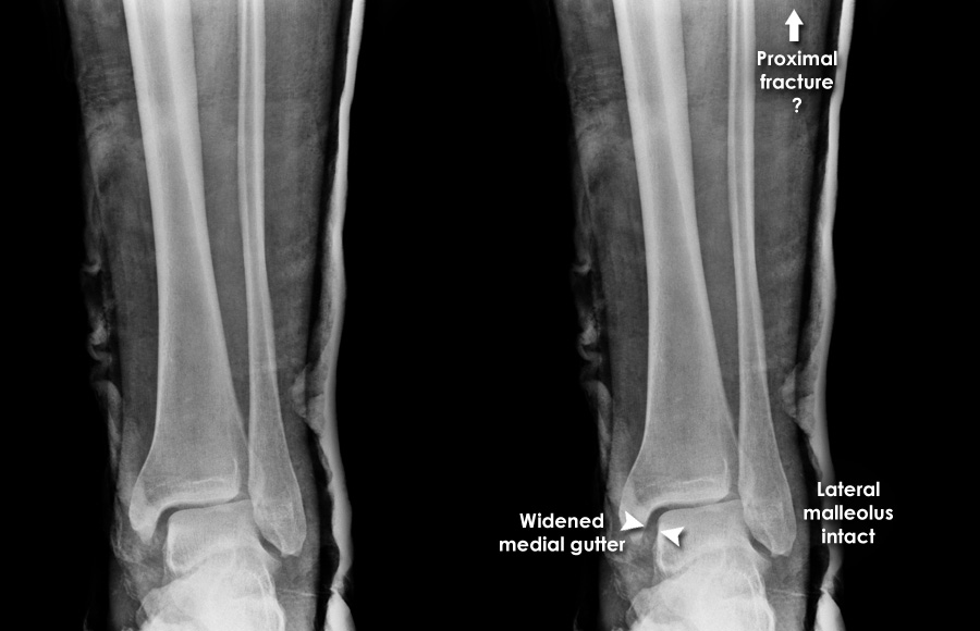 Maisonneuve Fracture Leg