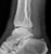 ankle_trimaleolar_a1_thumb.jpg