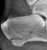 calcaneal_fracture_a1_thumb.jpg