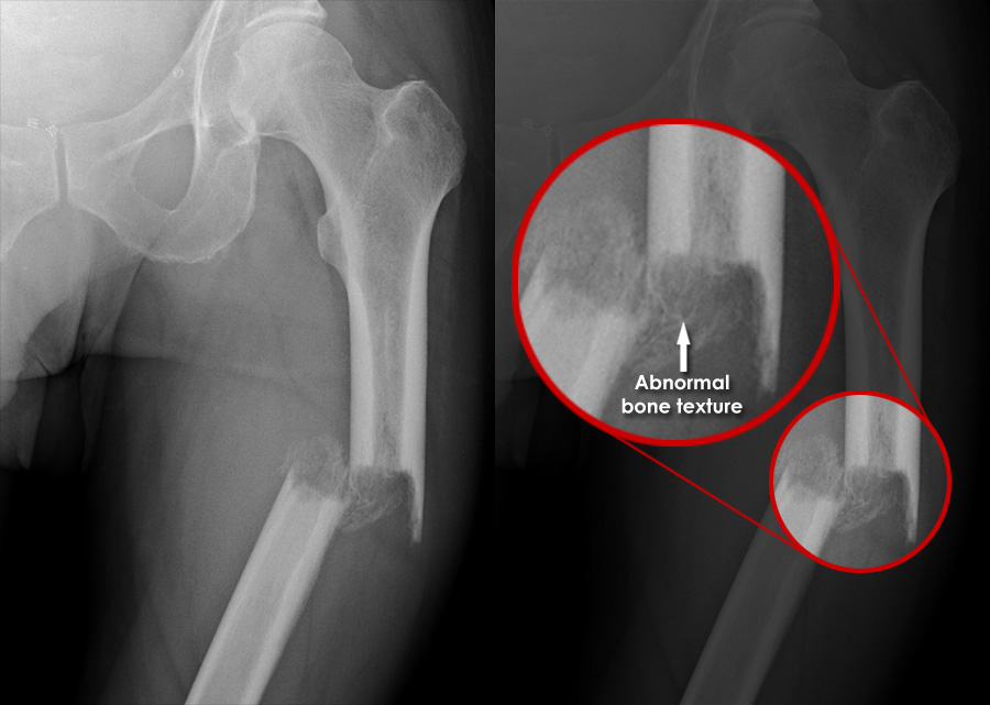 Trauma Xray Lower limb gallery 1 Femur