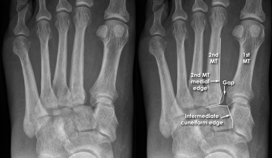 Trauma Xray Lower limb gallery 2 Foot Lisfranc injury