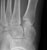 foot_lisfranc_a1_thumb.jpg