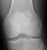 knee_patella_bipart_thumb.jpg