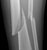 tibia_fib_fracture_a1_thumb.jpg