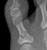 toe_fracture_a1_thumb.jpg