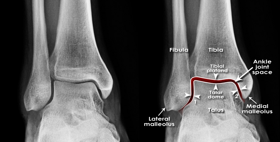 fractured ankle x ray