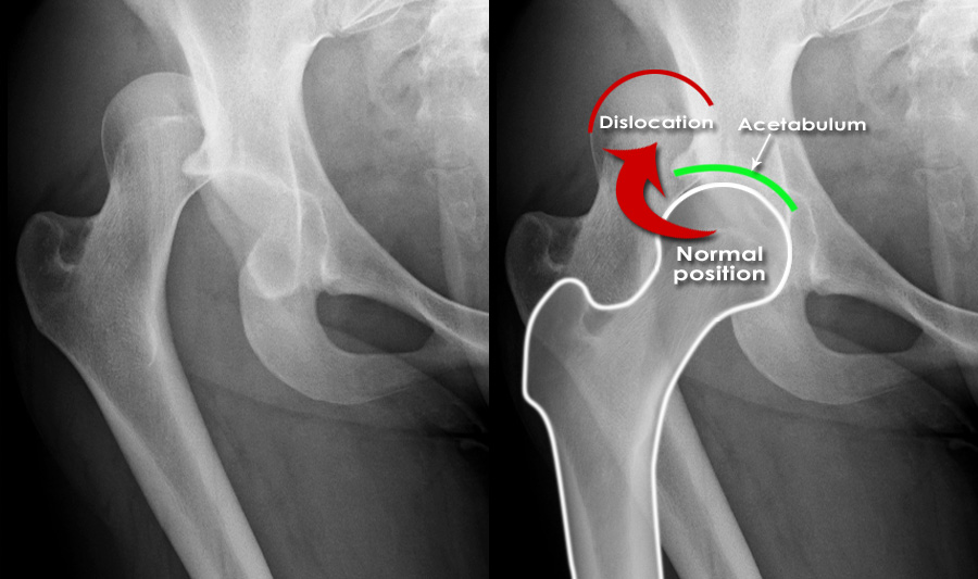 Trauma X Ray Lower Limb Hip Dislocation
