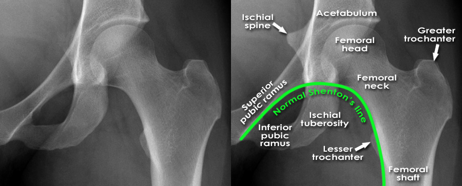 femur anatomy xray