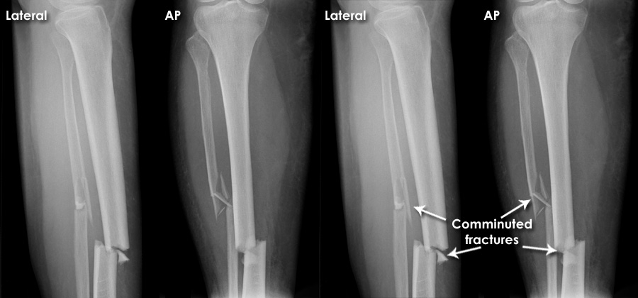 Trauma X-ray - Lower limb - Tibia and fibula