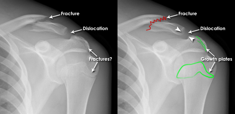 Introduction to Trauma X-ray - Fracture mimics