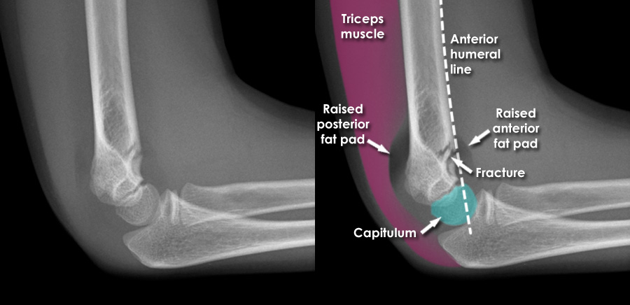 팔꿈치 상완골 상과골절(supracondylar fx. of humerus) xray : 네이버 블로그