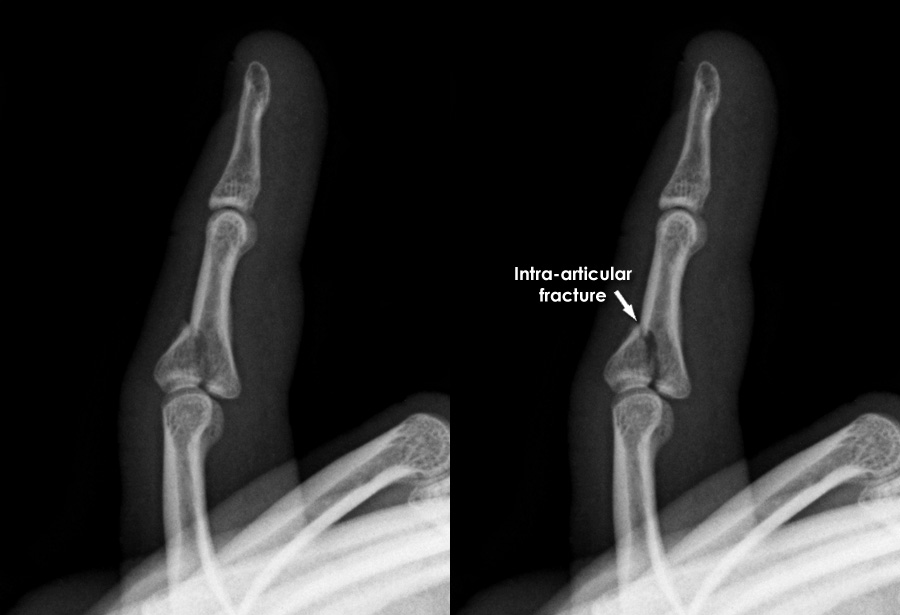 Trauma Xray Upper limb gallery 2 Finger fractures 1
