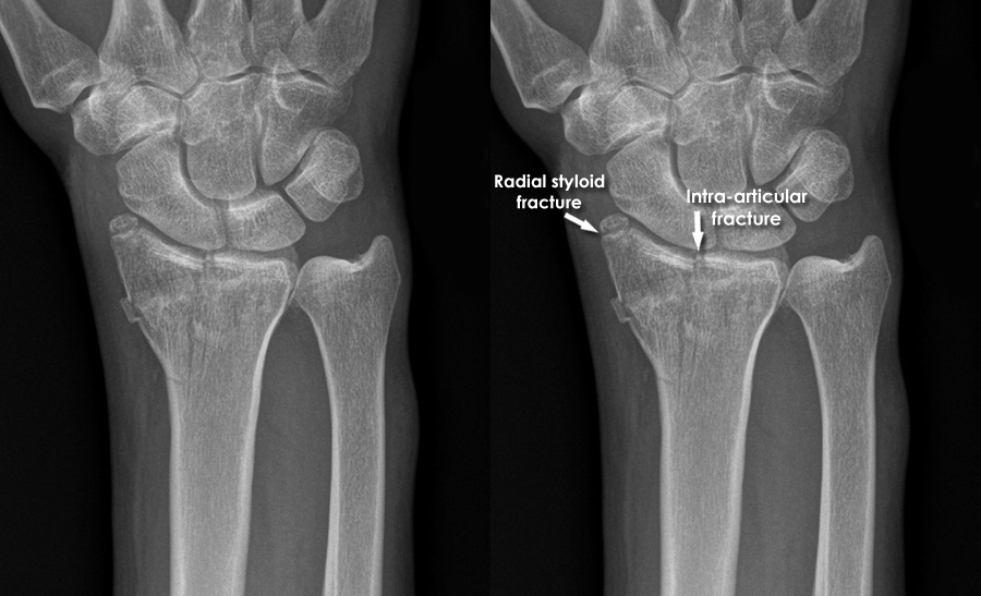 Trauma X-ray - Upper limb gallery 2 - Distal radius fracture