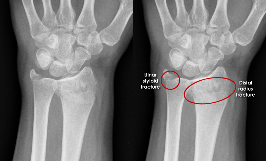 Trauma X-ray - Upper limb gallery 2 - Colles' fracture