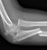 forearm_monteggia_a1_thumb.jpg