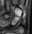 scaphoid_a2_thumb.jpg