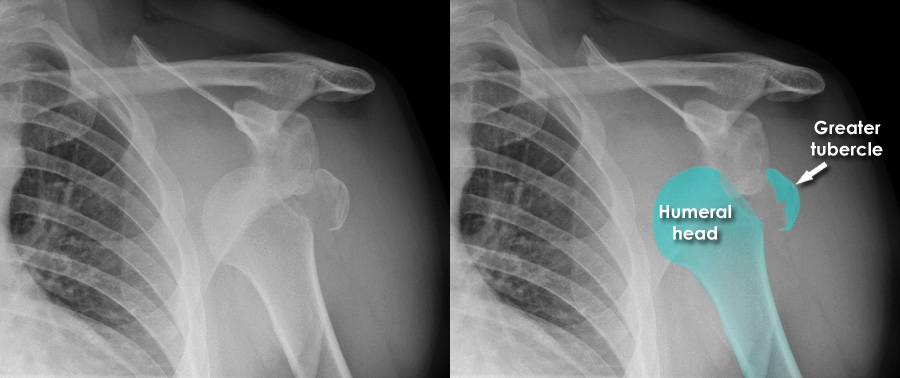 Trauma X-ray - Upper limb gallery 1 - Shoulder dislocation - Complications