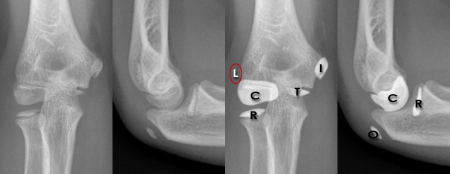 Trauma X-ray - Upper limb - Elbow