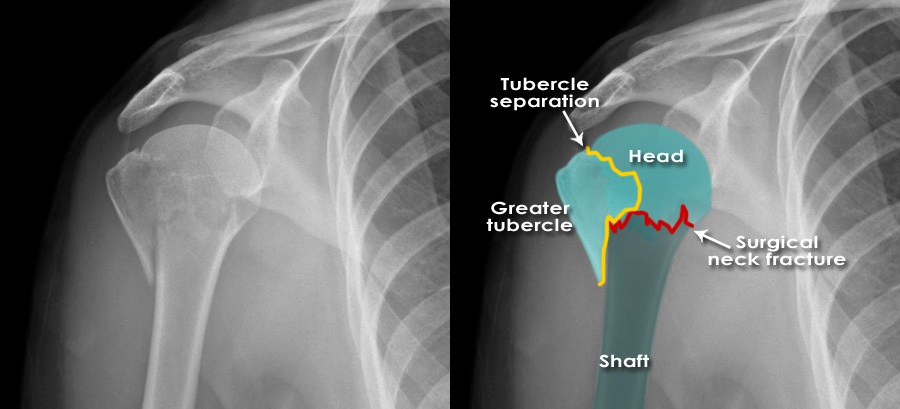 Humerus X Ray Humerus X Ray