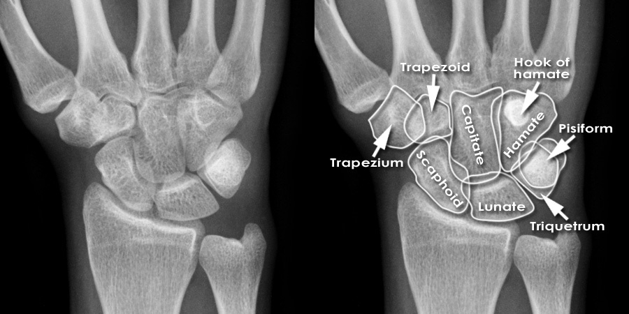 Trauma X-ray - Upper limb - Wrist